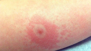 Ръст на случаите на лаймска болест: Какви са симптомите и кога да потърсим лекар